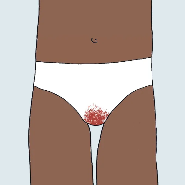 Illustration für Leichte Sprache: gezeigt wird der Ausschnitt einer Person von den Oberschenkeln bis oberhalb des Bauchnabels. Auf der weißen Unterhose sieht man Blutflecken, die auf die Blutung bei einer Fehlgeburt hindeuten.